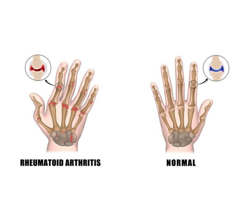 Турмалінові компресійні рукавички від артриту пальців кисті з біофотонами