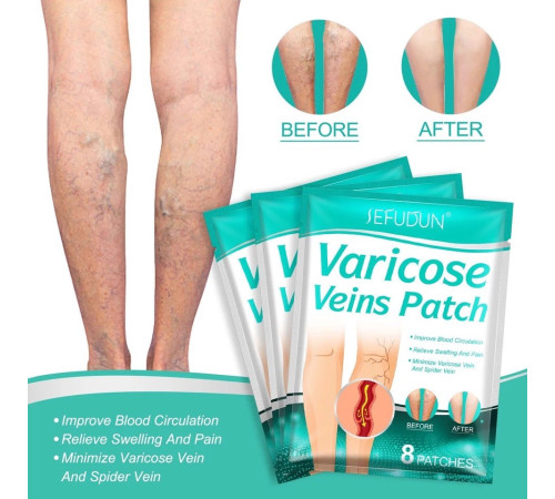 Пластир проти варикозного розширення вен і судинних зірочок на ногах 8 шт.