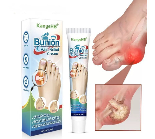 КРЕМ ВІД ШКІРКИ НА НІГЕ (HALLUX VALGUS) Bunion Pain Relief Cream — комфорт, легкість і турбота про ваші ноги щодня