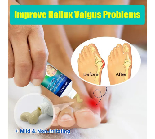 КРЕМ ВІД ШКІРКИ НА НІГЕ (HALLUX VALGUS) Bunion Pain Relief Cream — комфорт, легкість і турбота про ваші ноги щодня